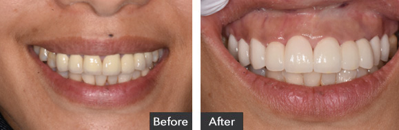 Before and After Full Mouth Rehab