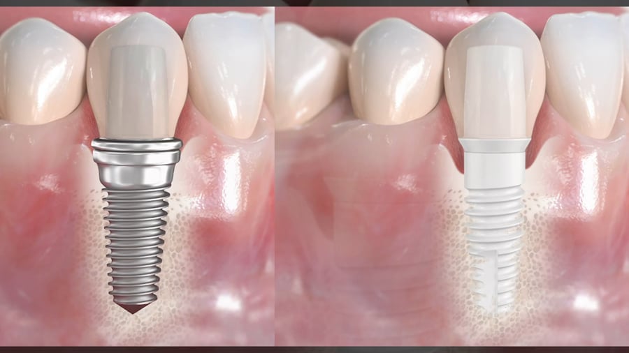 dental implants ceramic