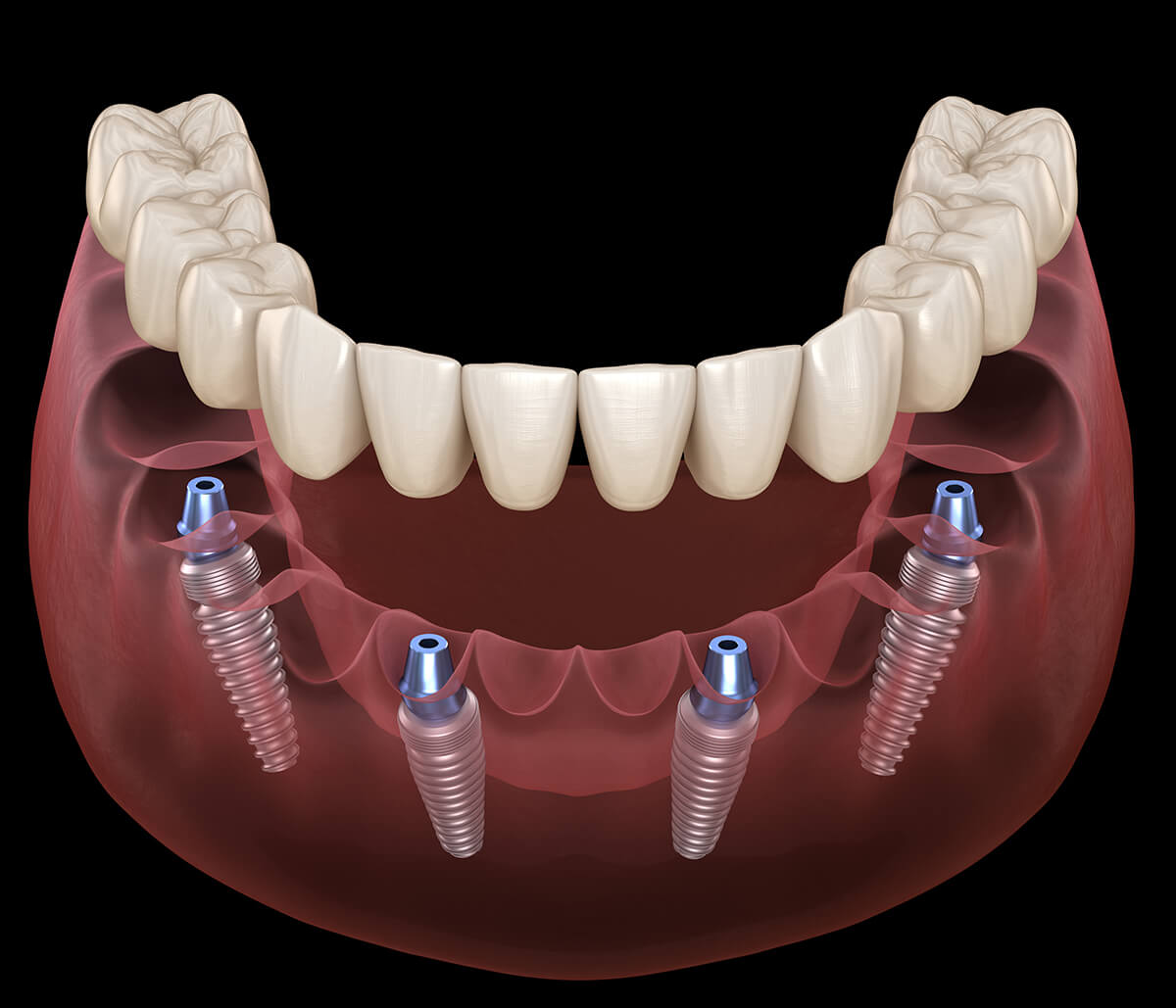 Implant Supported Dentures in Beverly Hills Area