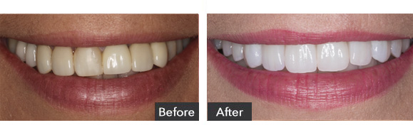 Veneers before after results - Beverly Hills, CA