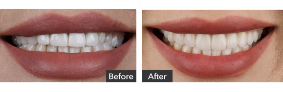Porcelain Veneers before and after results Beverly Hills, CA