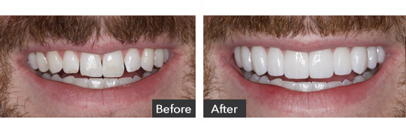 Porcelain Veneers before and after results Beverly Hills, CA, case-4