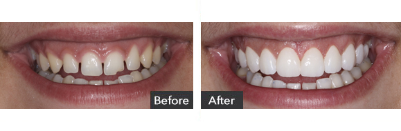 Porcelain Veneers before and after results Beverly Hills, CA, case-5