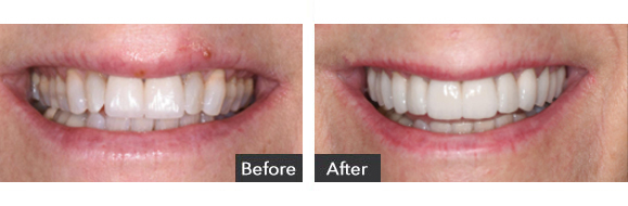 Veneers before and after results Beverly Hills, CA, case-6